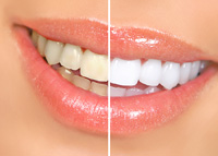 Teeth Whitening | Dentist in Charlotte, NC | Carberry Family Dentistry
