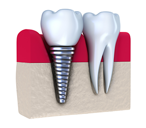 Dental Implants | Dentist in Charlotte, NC | Carberry Family Dentistry